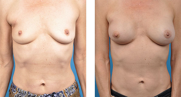Breast Reconstruction Revision patient images