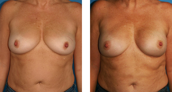 Bilateral nipple/areola-sparing mastectomy with Cassileth One-Stage Breast Reconstruction before and after
