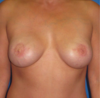 Breast reconstruction before and after