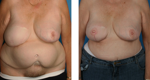 breast TRAM flap reconstruction, nipple/areola reconstruction before and after pictures