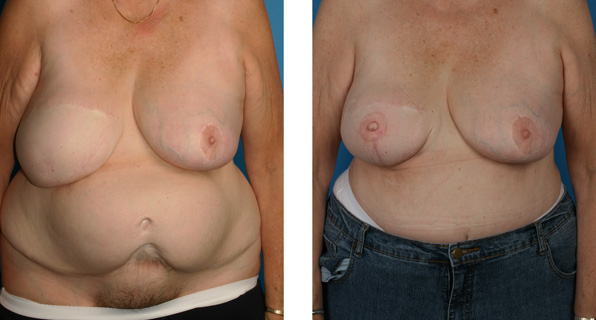 breast TRAM flap reconstruction, nipple/areola reconstruction before and after pictures