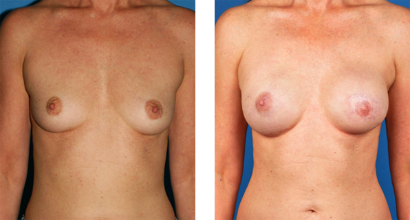 nipple and areola sparing mastectomy and Left skin sparing mastectomy with Cassileth One-Stage Breast Reconstruction