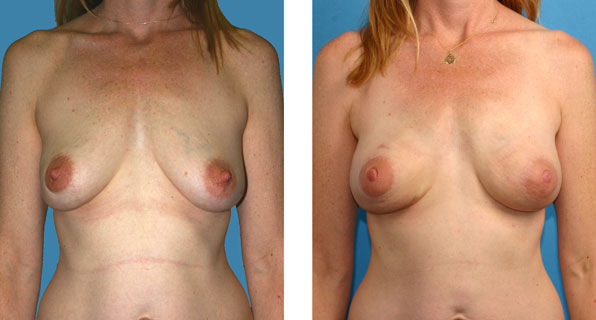 Bilateral nipple/areola-sparing mastectomy with One-Stage Breast Reconstruction before & after