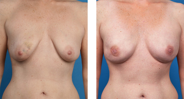 Bilateral nipple-sparing mastectomy, One-Stage Breast Reconstruction