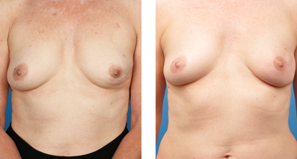 breast nipple/areola-sparing mastectomy with Cassileth One-Stage Breast Reconstruction before and after