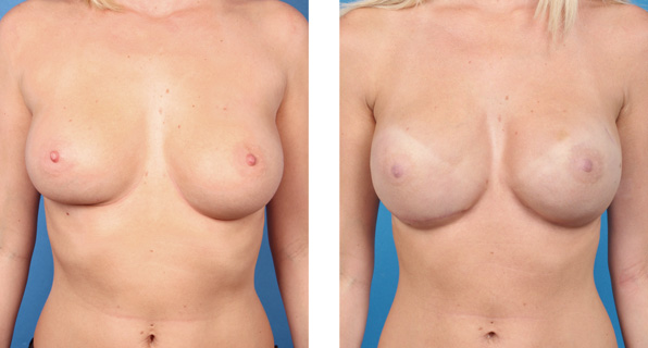 Bilateral nipple/areola-sparing mastectomy with Cassileth One-Stage Breast Reconstruction patient photo