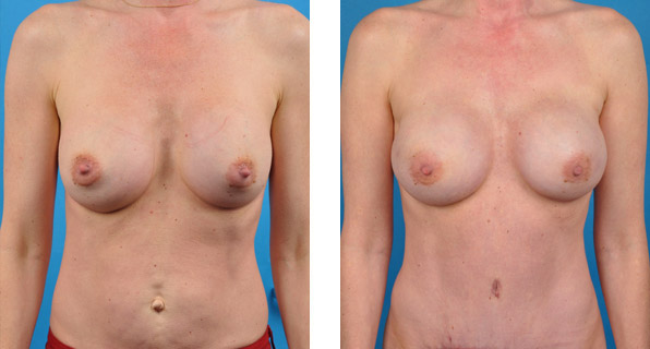 BRCA + bilateral prophylactic mastectomies with One-Stage Breast Reconstruction patient images