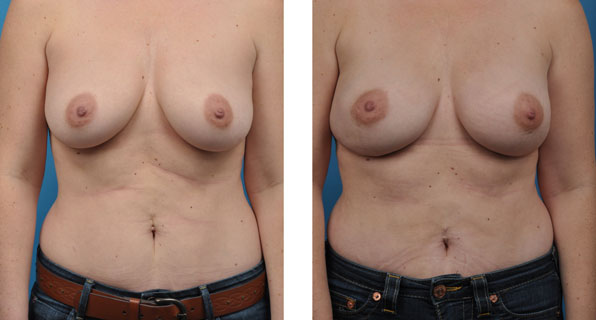 BRCA + prophylactic bilateral mastectomies with one-stage breast reconstruction patient before and after
