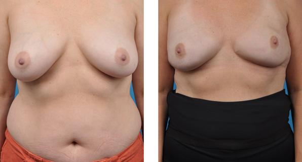 bilateral mastectomy with Cassileth One-Stage Breast Reconstruction