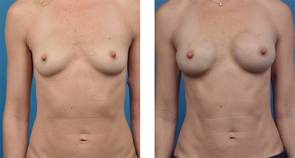 bilateral mastectomy with One-Stage Breast Reconstruction patient