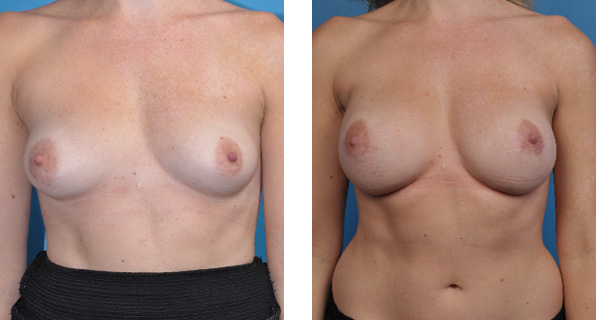bilateral mastectomy and One-Stage Breast Reconstruction patient images