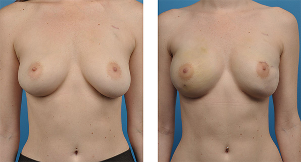 bilateral mastectomy and One-Stage Breast Reconstruction Patient photos