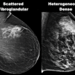 beverly hills mammogram comparing breast density