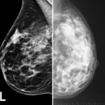 digital mammogram vs coventional mammogram