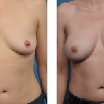 one-stage-breast-reconstruction-23-ap