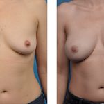 one-stage-breast-reconstruction-23-ap