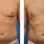 gynecomastia surgery before & after