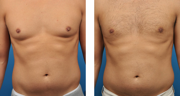 los angeles gynecomastia surgery before and after front view