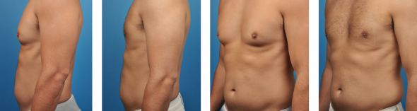 Gynecomastia Surgery Los Angeles 