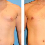 Gyn-01 Frontal Age 33 from Burbank, California. Patient was unhappy with breast like bulges on his chest. Bilateral gynecomastia surgery was performed.