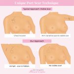 Invisible Port Scar Technique – Bedford Breast Center