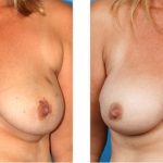 reasons to have breast reconstruction – Beverly Hills