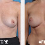 Diep Flap vs. Implant Reconstruction – Beverly Hills