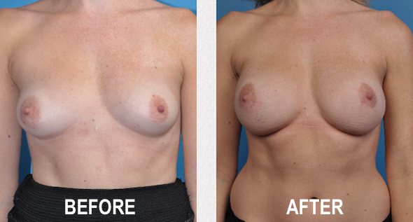 diep flap breast reconstruction surgery before and after results in Beverly Hills, CA