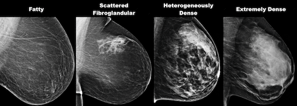mammogram screening comparison chart from Bedford Breast Center in Beverly Hills, CA