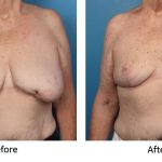 diep flap breast reconstruction – Beverly Hills – CA