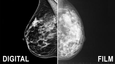 side by side comparison of a conventional mammogram and a digital mammogram offered at Bedford Breast Center in Beverly Hills, CA