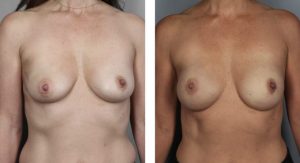 before and after breast photos