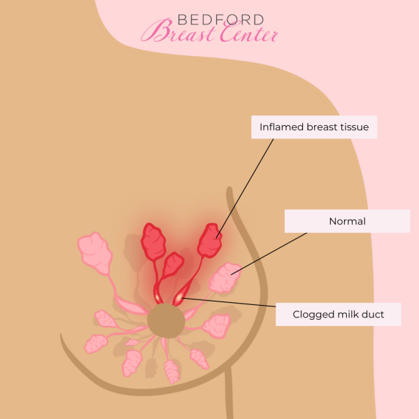 Breast graphic showing inflamed breast tissue