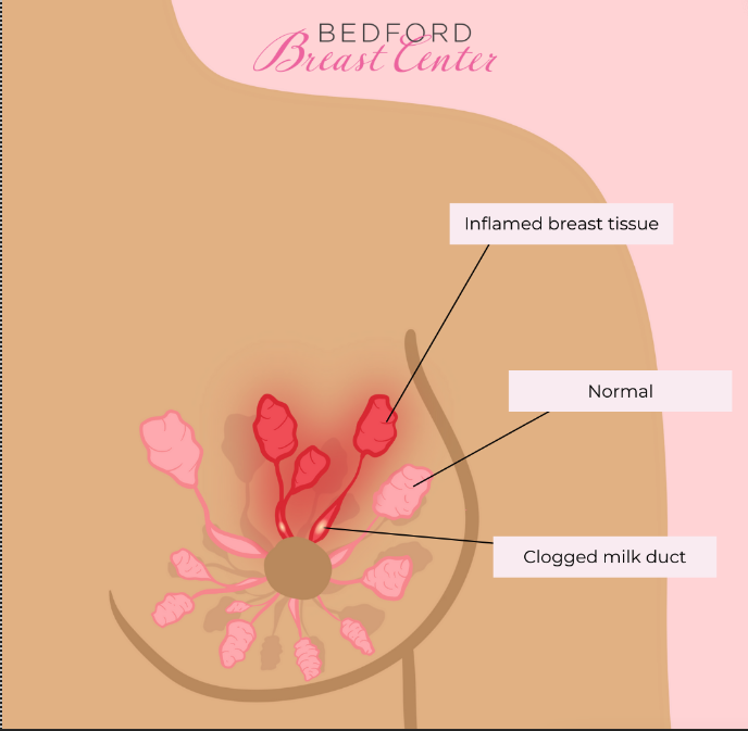 Illustration showing what mastitis looks like in the breast.