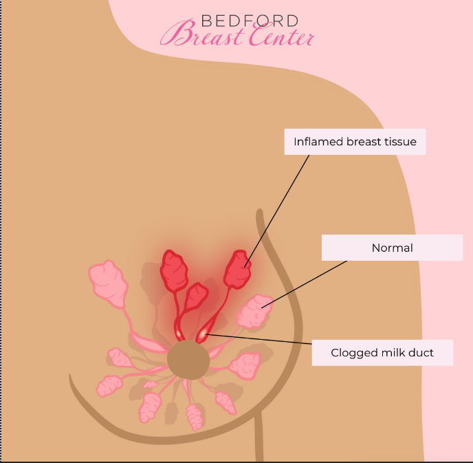 Breast Yeast Infection and How To Help Yourself